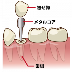 差し歯というものは「クラウン」と呼ばれるもので、自身の歯を削って形を整えて、そのうえに人口の歯を被せる方法です