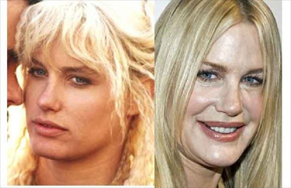 ハリウッド女優の整形ビフォーアフター1